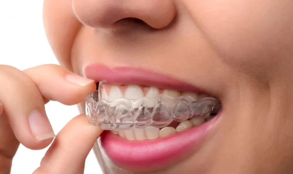 orthodontic-underbite-correction:-modern-techniques-for-a-better-smile